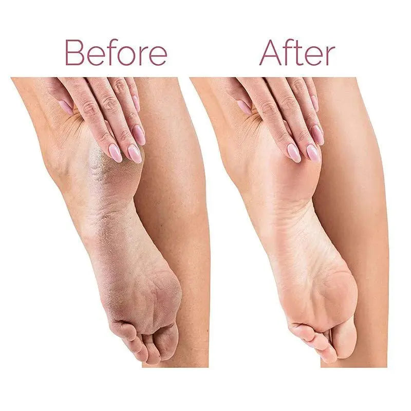 Electric Pedicure Foot File Callus Remover - SAND's CART